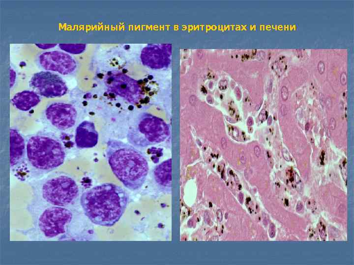 Малярийный пигмент в эритроцитах и печени 