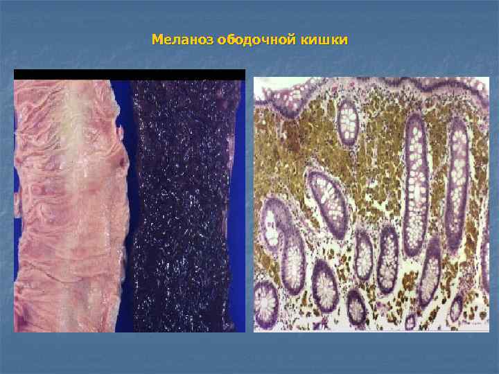 Меланоз ободочной кишки 
