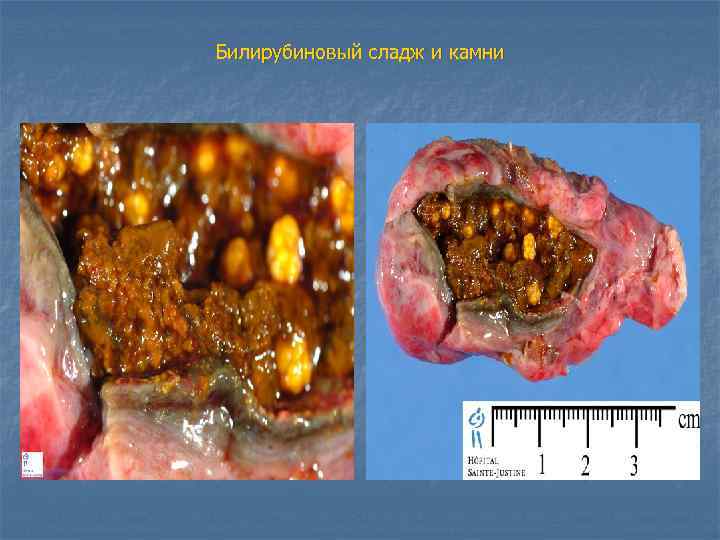 Билирубиновый сладж и камни 