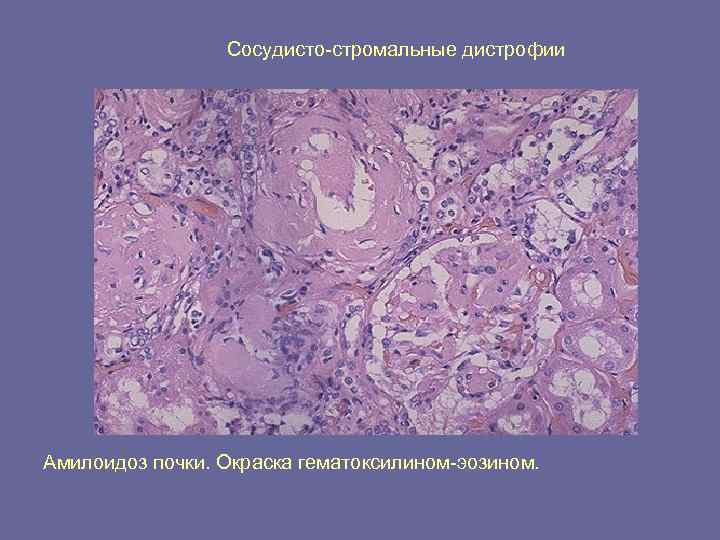 Сосудисто-стромальные дистрофии Амилоидоз почки. Окраска гематоксилином-эозином. 