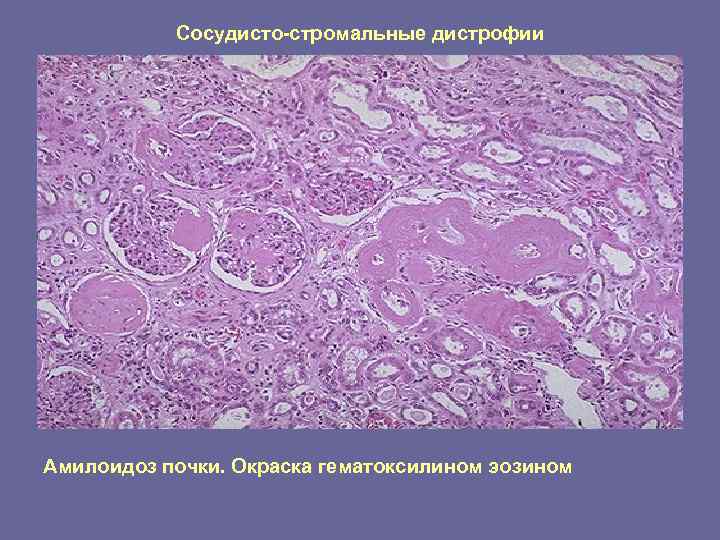 Сосудисто-стромальные дистрофии Амилоидоз почки. Окраска гематоксилином эозином 