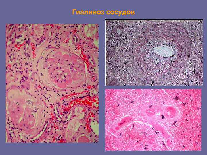Гиалиноз сосудов 