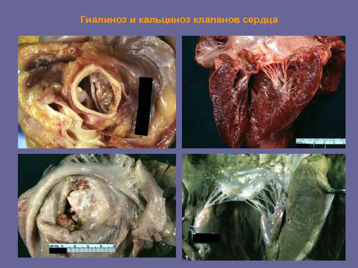 Гиалиноз и кальциноз клапанов сердца 