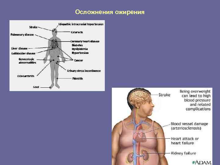 Осложнения ожирения 