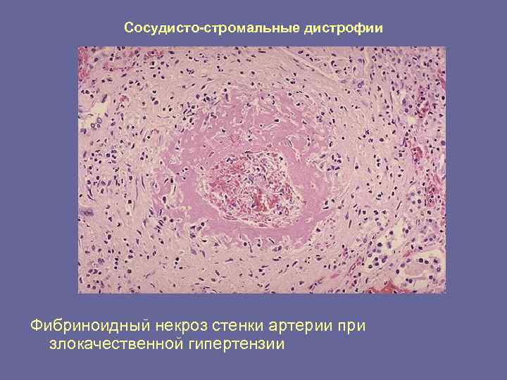 Сосудисто-стромальные дистрофии Фибриноидный некроз стенки артерии при злокачественной гипертензии 