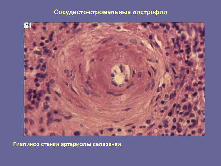 Сосудисто-стромальные дистрофии Гиалиноз стенки артериолы селезенки 