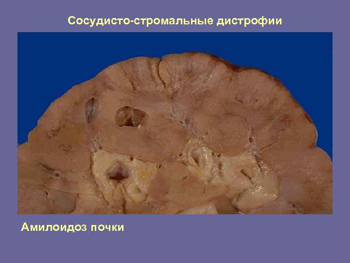 Сосудисто-стромальные дистрофии Амилоидоз почки 