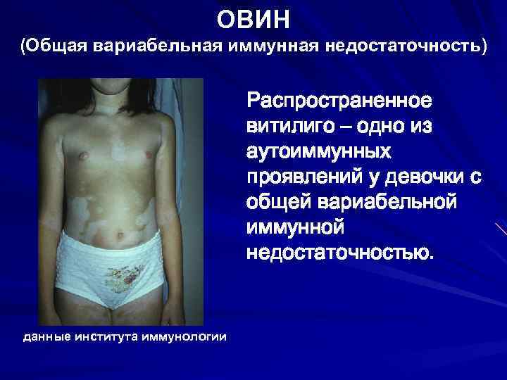 ОВИН (Общая вариабельная иммунная недостаточность) Распространенное витилиго – одно из аутоиммунных проявлений у девочки
