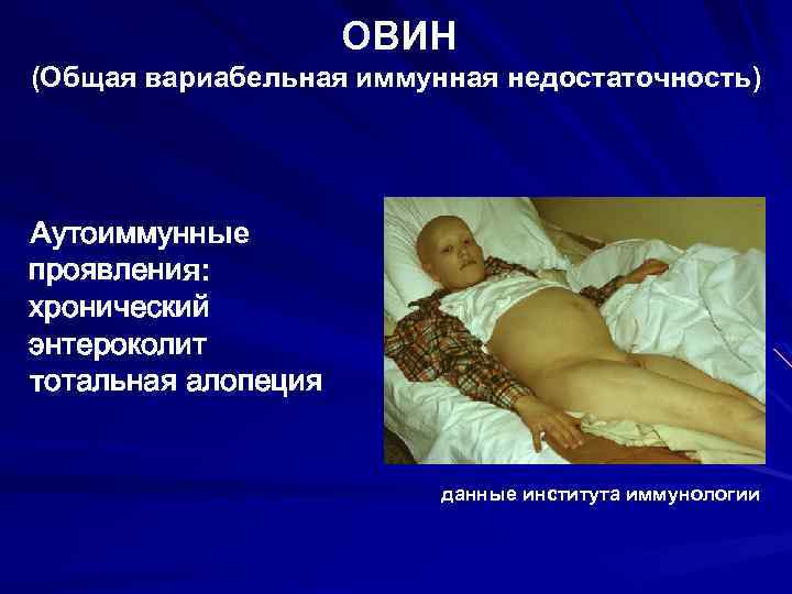 ОВИН (Общая вариабельная иммунная недостаточность) Аутоиммунные проявления: хронический энтероколит тотальная алопеция данные института иммунологии