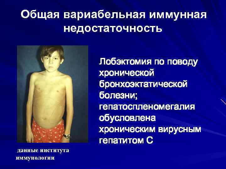 Общая вариабельная иммунная недостаточность данные института иммунологии Лобэктомия по поводу хронической бронхоэктатической болезни; гепатоспленомегалия