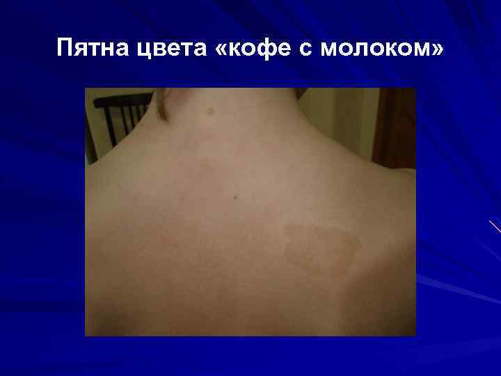 Пятна цвета «кофе с молоком» 