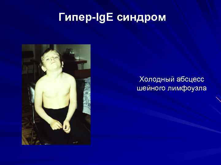 Гипер-Ig. E синдром Холодный абсцесс шейного лимфоузла 