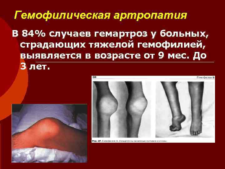 Гемофилическая артропатия В 84% случаев гемартроз у больных,  страдающих тяжелой гемофилией,  выявляется