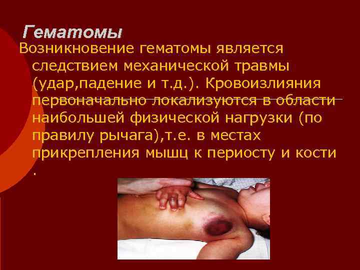Гематомы Возникновение гематомы является  следствием механической травмы  (удар, падение и т. д.