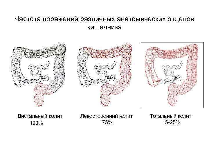 Частота поражений различных анатомических отделов кишечника Дистальный колит Левосторонний колит Тотальный колит 100% 75%