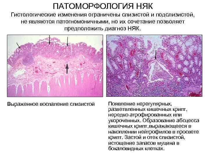  ПАТОМОРФОЛОГИЯ НЯК Гистологические изменения ограничены слизистой и подслизистой, не являются патогномоничными, но их