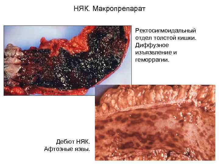  НЯК. Макропрепарат Ректосигмоидальный отдел толстой кишки. Диффузное изъязвление и геморрагии. Дебют НЯК. Афтозные