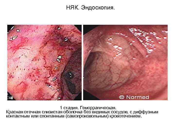  НЯК. Эндоскопия. 1 стадия. Геморрагическая. Красная отечная слизистая оболочка без видимых сосудов, с