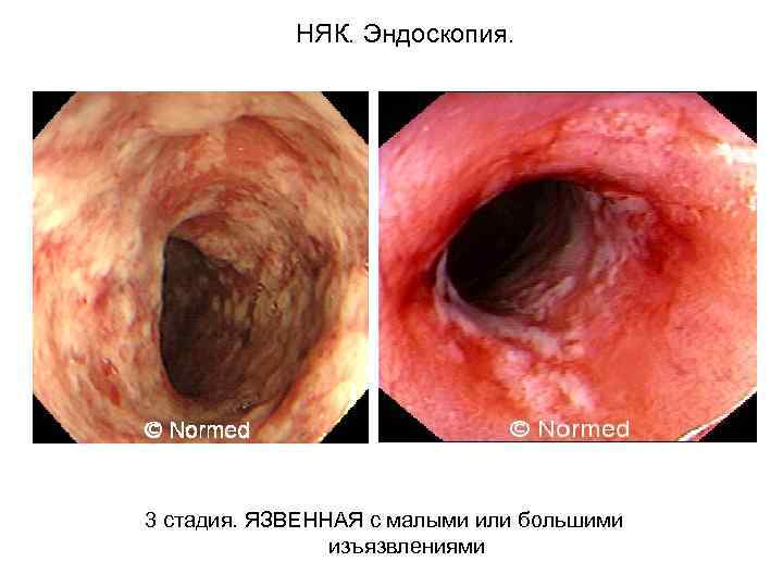  НЯК. Эндоскопия. 3 стадия. ЯЗВЕННАЯ с малыми или большими изъязвлениями 