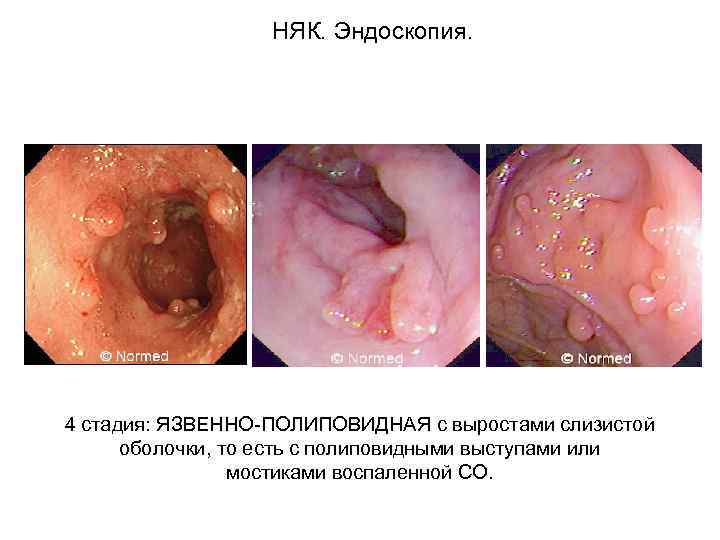  НЯК. Эндоскопия. 4 стадия: ЯЗВЕННО-ПОЛИПОВИДНАЯ с выростами слизистой оболочки, то есть с полиповидными