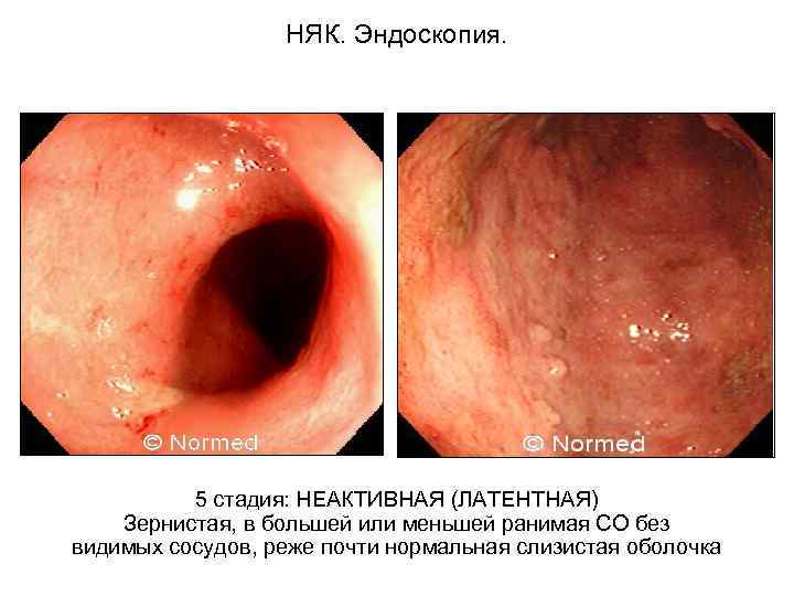  НЯК. Эндоскопия. 5 стадия: НЕАКТИВНАЯ (ЛАТЕНТНАЯ) Зернистая, в большей или меньшей ранимая СО