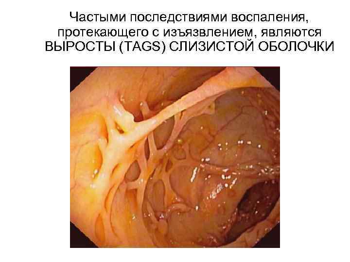  Частыми последствиями воспаления, протекающего с изъязвлением, являются ВЫРОСТЫ (TAGS) СЛИЗИСТОЙ ОБОЛОЧКИ 