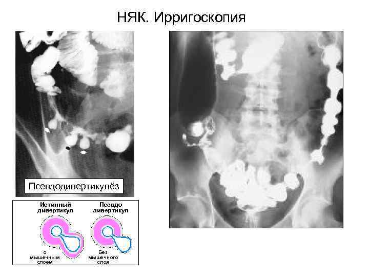  НЯК. Ирригоскопия Псевдодивертикулёз Истинный Псевдо дивертикул с Без мышечным мышечного слоем слоя 