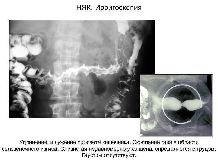  НЯК. Ирригоскопия Удлинение и сужение просвета кишечника. Скопление газа в области селезеночного изгиба.