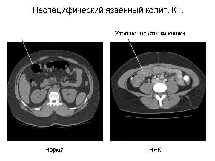 Утолщение стенок прямой кишки