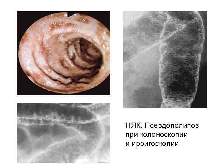 НЯК. Псевдополипоз при колоноскопии и ирригоскопии 