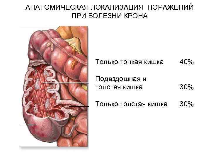 АНАТОМИЧЕСКАЯ ЛОКАЛИЗАЦИЯ ПОРАЖЕНИЙ ПРИ БОЛЕЗНИ КРОНА Только тонкая кишка 40% Подвздошная и толстая кишка