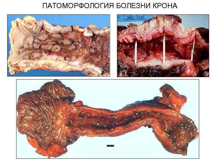 ПАТОМОРФОЛОГИЯ БОЛЕЗНИ КРОНА 