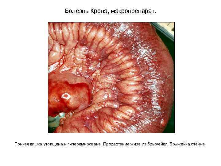 Болезнь Крона, макропрепарат. Тонкая кишка утолщена и гиперемирована. Прорастание жира из брыжейки. Брыжейка