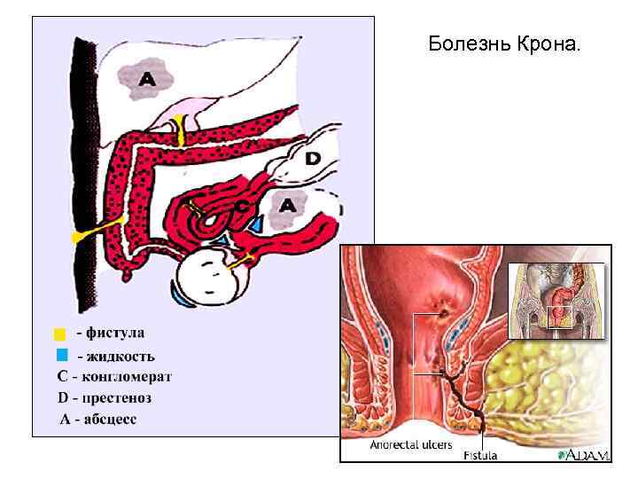 Болезнь Крона. 