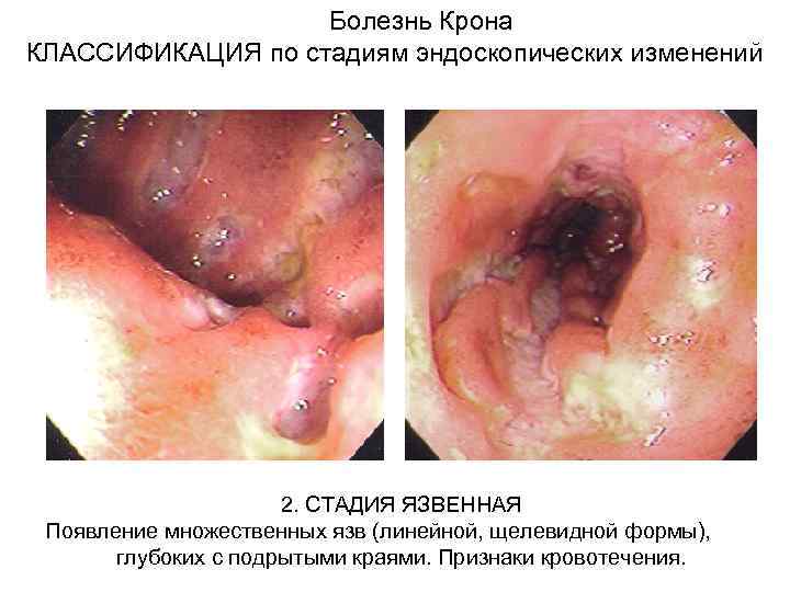  Болезнь Крона КЛАССИФИКАЦИЯ по стадиям эндоскопических изменений 2. СТАДИЯ ЯЗВЕННАЯ Появление множественных язв