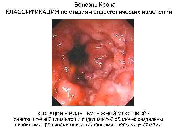  Болезнь Крона КЛАССИФИКАЦИЯ по стадиям эндоскопических изменений 3. СТАДИЯ В ВИДЕ «БУЛЫЖНОЙ МОСТОВОЙ»