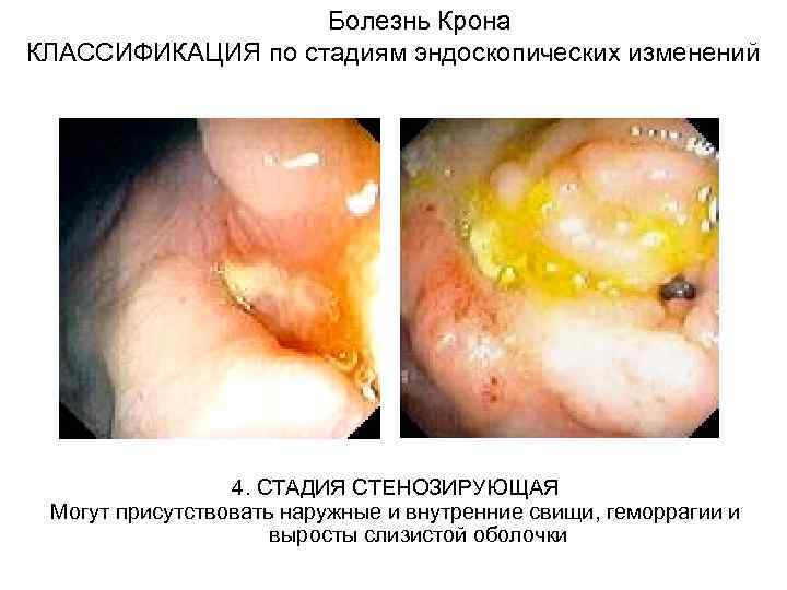  Болезнь Крона КЛАССИФИКАЦИЯ по стадиям эндоскопических изменений 4. СТАДИЯ СТЕНОЗИРУЮЩАЯ Могут присутствовать наружные