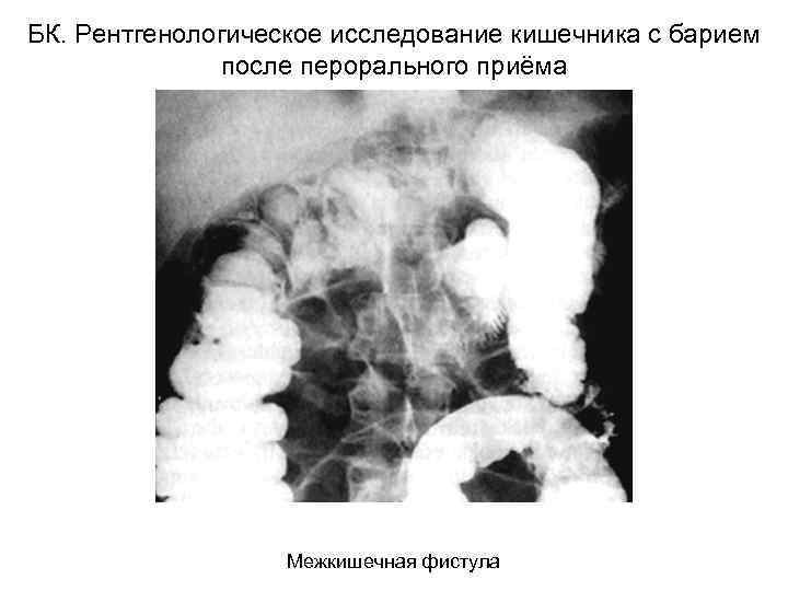 БК. Рентгенологическое исследование кишечника с барием после перорального приёма Межкишечная фистула 