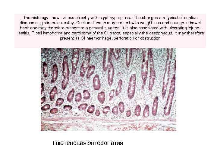  The histology shows villous atrophy with crypt hyperplasia. The changes are typical of