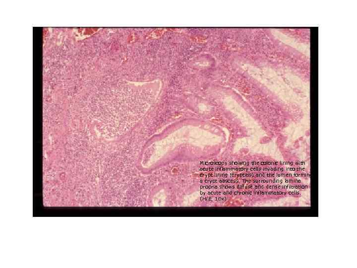 Microscopy showing the colonic lining with acute inflammatory cells invading into the crypt lining