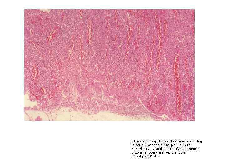 Ulcerated lining of the colonic mucosa, lining intact at the edge of the picture,