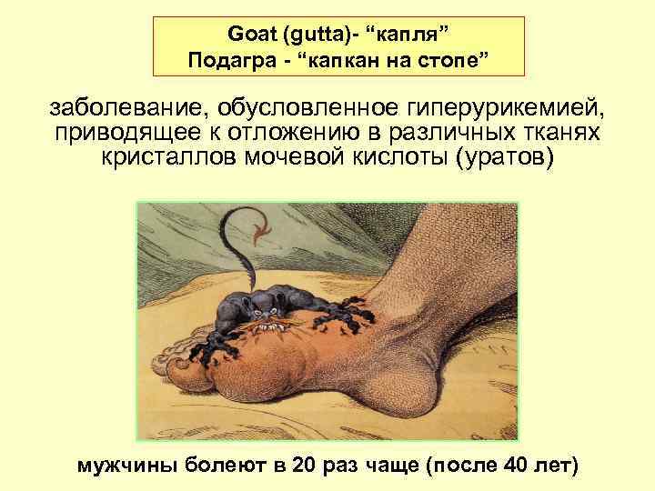 Goat (gutta)- “капля” Подагра - “капкан на стопе” заболевание, обусловленное гиперурикемией, приводящее к отложению