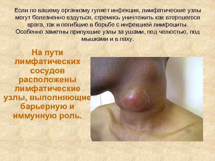  Если по вашему организму гуляет инфекция, лимфатические узлы  могут болезненно вздуться, стремясь