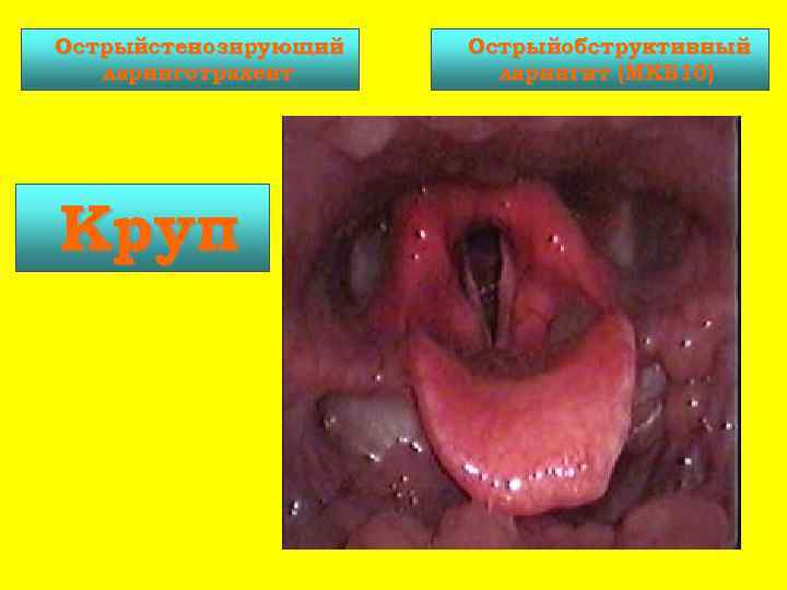Острыйстенозирующий Острыйобструктивный  ларинготрахеит   ларингит (МКБ 10) Круп    