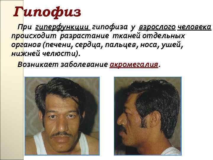 Гипофиз При гиперфункции гипофиза у взрослого человека происходит разрастание тканей отдельных органов (печени, сердца,