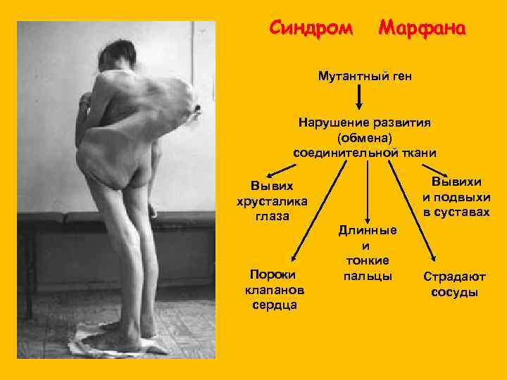 Синдром Марфана Мутантный ген Нарушение развития (обмена) соединительной ткани Вывих хрусталика глаза Пороки клапанов