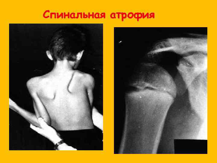 Спинальная атрофия 