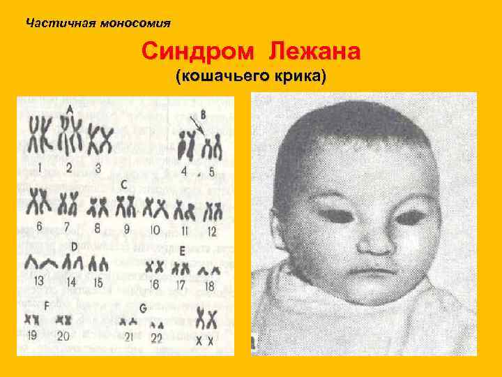 Частичная моносомия Синдром Лежана (кошачьего крика) 