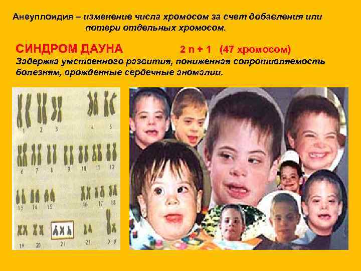 Анеуплоидия – изменение числа хромосом за счет добавления или потери отдельных хромосом. СИНДРОМ ДАУНА