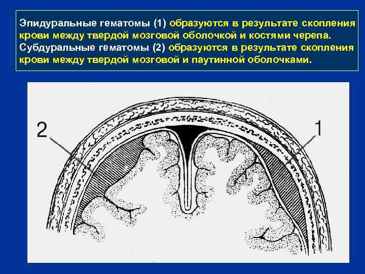 Эпидуральные гематомы (1) образуются в результате скопления крови между твердой мозговой оболочкой и костями